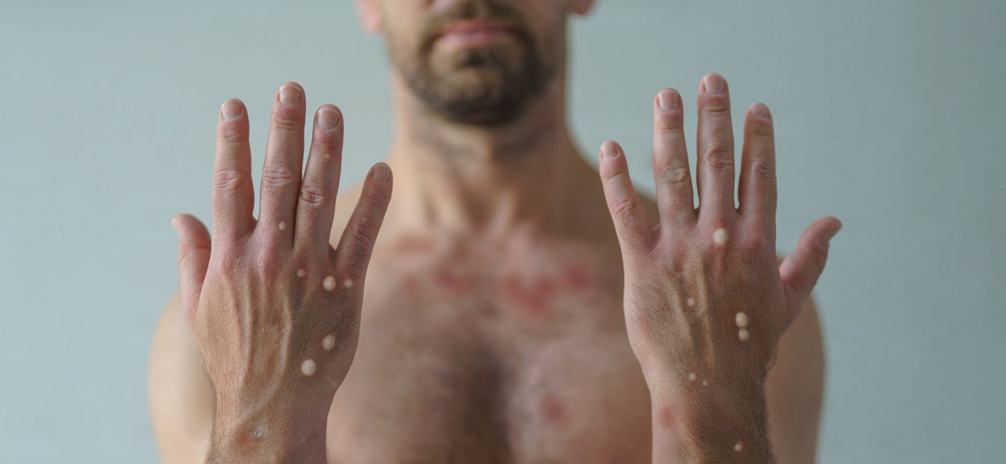 You can still get life insurance, critical illness insurance, and disability insurance if you've had monkeypox.